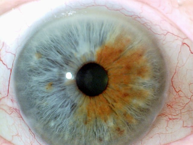 Iridology Eye Color Change Brown Eyes