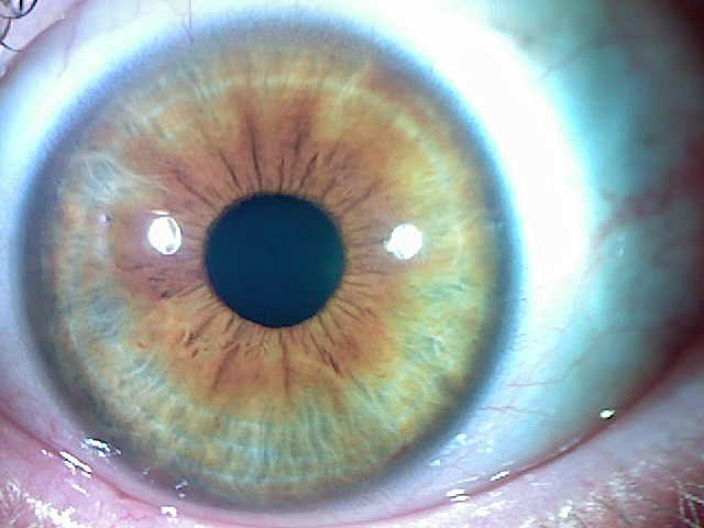 Iridology Eye Color Change Brown Eyes