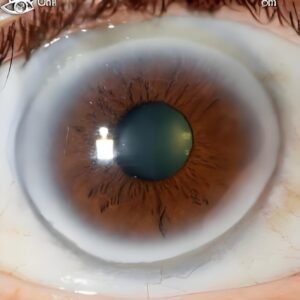 Black ring around the iris: practical guidance for UK holistic health practitioners — Iridología (3).jpg