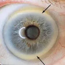 Black ring around the iris: practical guidance for UK holistic health practitioners — Iridology Iris sodium ring (2).jpg