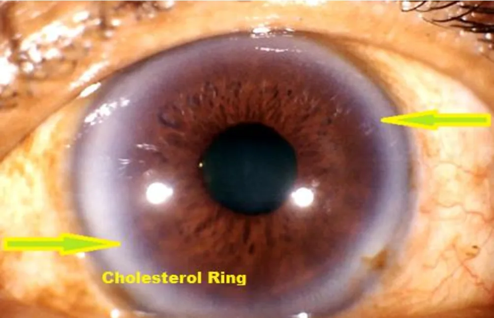 Black ring around the iris: practical guidance for UK holistic health practitioners — Iridology Iris sodium ring (1).png