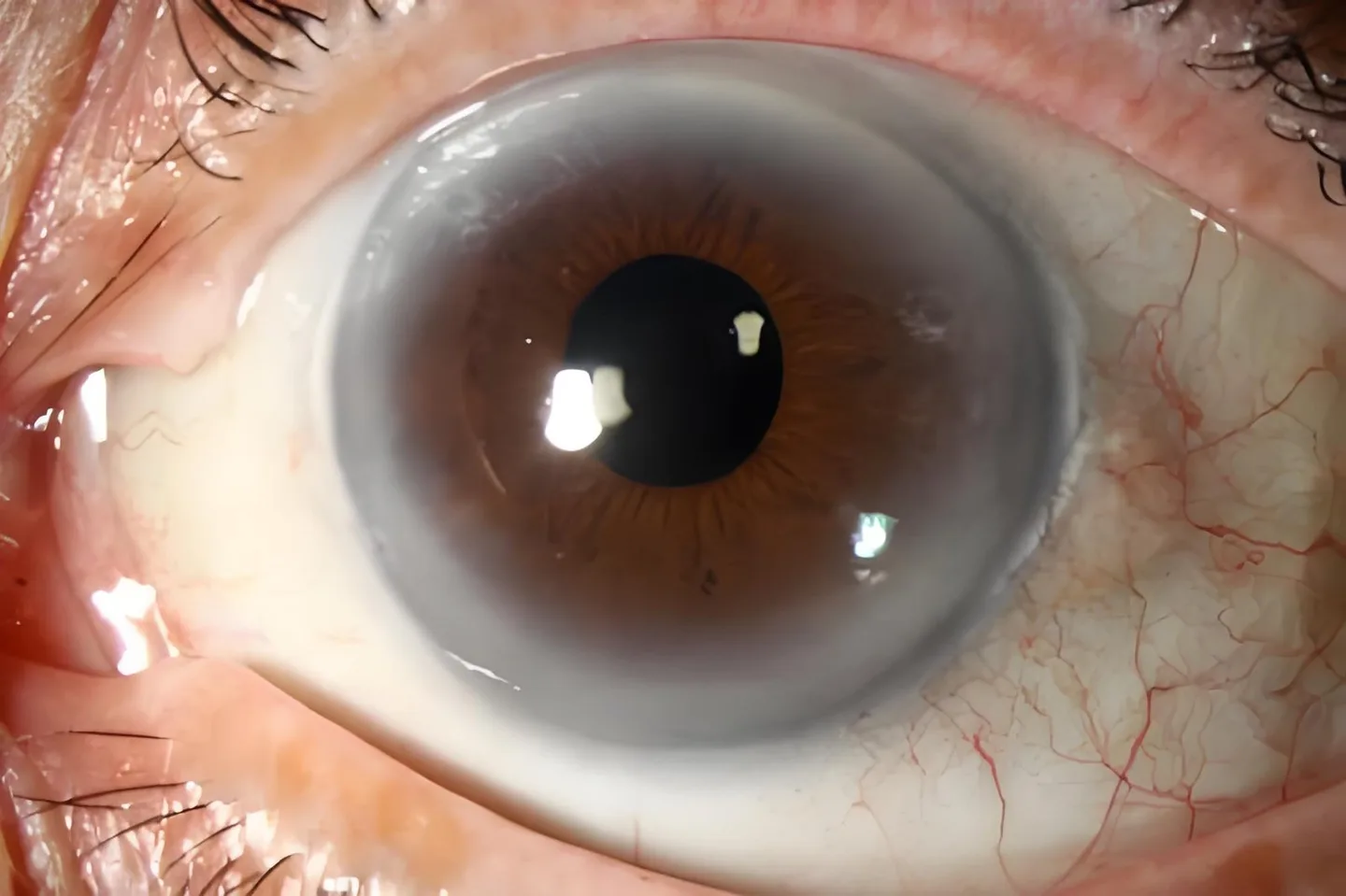 Black ring around the iris: practical guidance for UK holistic health practitioners — Iridology Iris sodium ring (4).jpg