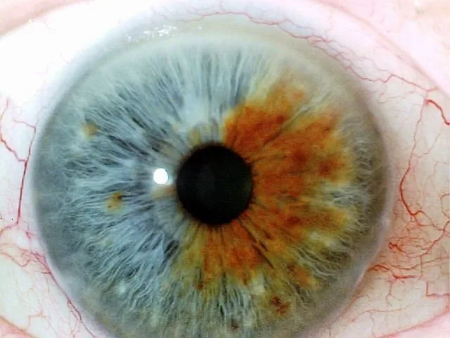 How Iris Analysis Fits into Your Biohacking Stack: Practical Guidance for UK Complementary Therapy Practitioners — Iridología (3).jpg